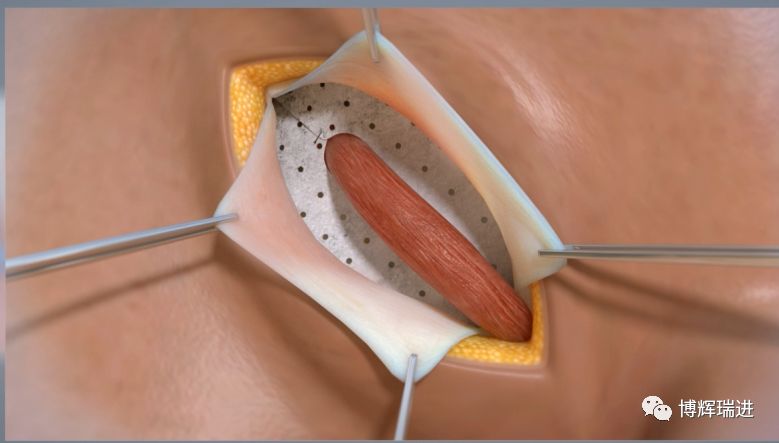 公司历经十年自主研发生产的腹股沟疝生物补片成功取得了国家食品药品